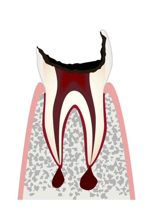 虫歯が歯根まで進行した状態