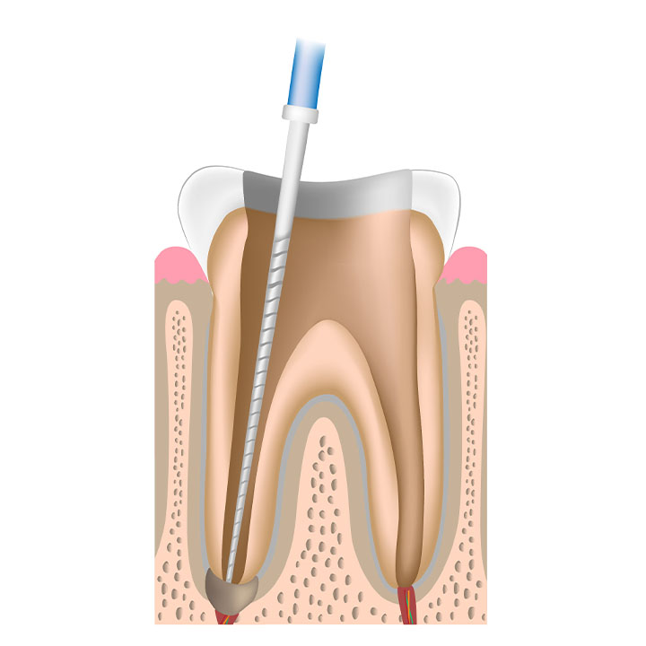 感染歯髄を除去、根管の拡大、薬液による洗浄
