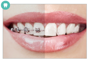 マウスピース矯正のメリット・デメリット（注意点）